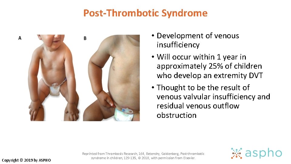 Post-Thrombotic Syndrome • Development of venous insufficiency • Will occur within 1 year in Post-Thrombotic Syndrome • Development of venous insufficiency • Will occur within 1 year in