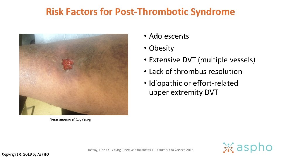Risk Factors for Post-Thrombotic Syndrome • Adolescents • Obesity • Extensive DVT (multiple vessels) Risk Factors for Post-Thrombotic Syndrome • Adolescents • Obesity • Extensive DVT (multiple vessels)