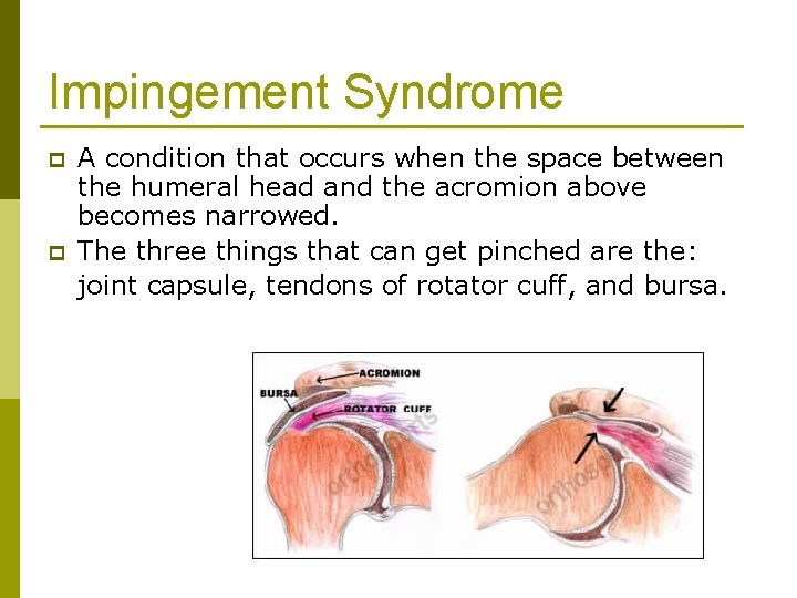 Impingement Syndrome p p A condition that occurs when the space between the humeral