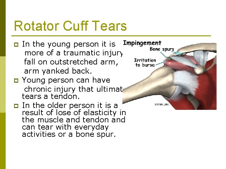 Rotator Cuff Tears p p p In the young person it is more of