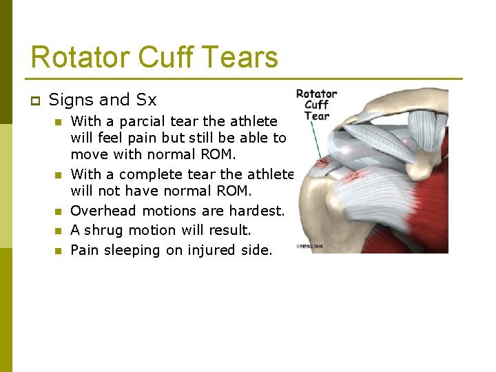 Rotator Cuff Tears p Signs and Sx n n n With a parcial tear