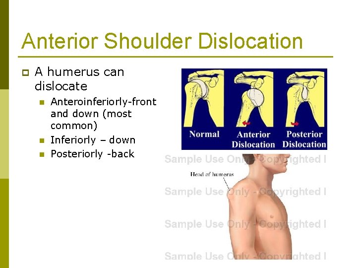 Anterior Shoulder Dislocation p A humerus can dislocate n n n Anteroinferiorly-front and down