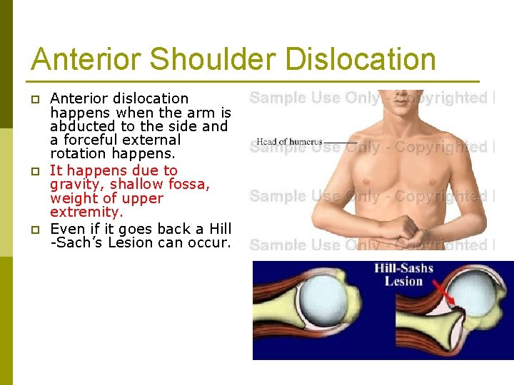 Anterior Shoulder Dislocation p p p Anterior dislocation happens when the arm is abducted