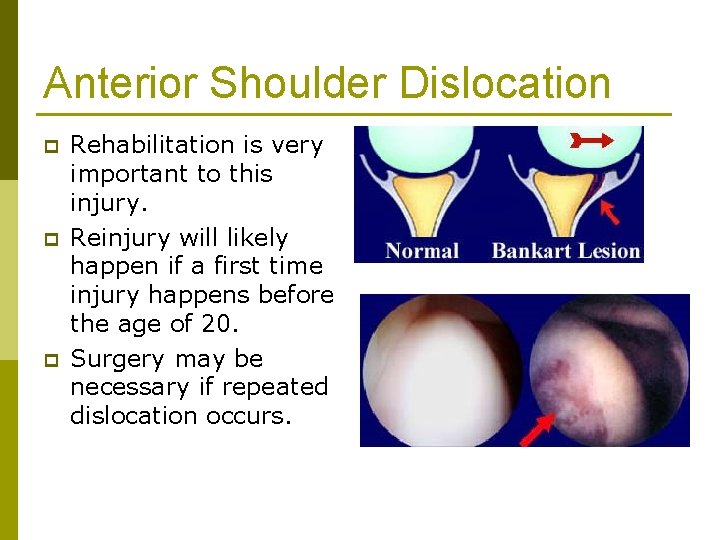 Anterior Shoulder Dislocation p p p Rehabilitation is very important to this injury. Reinjury