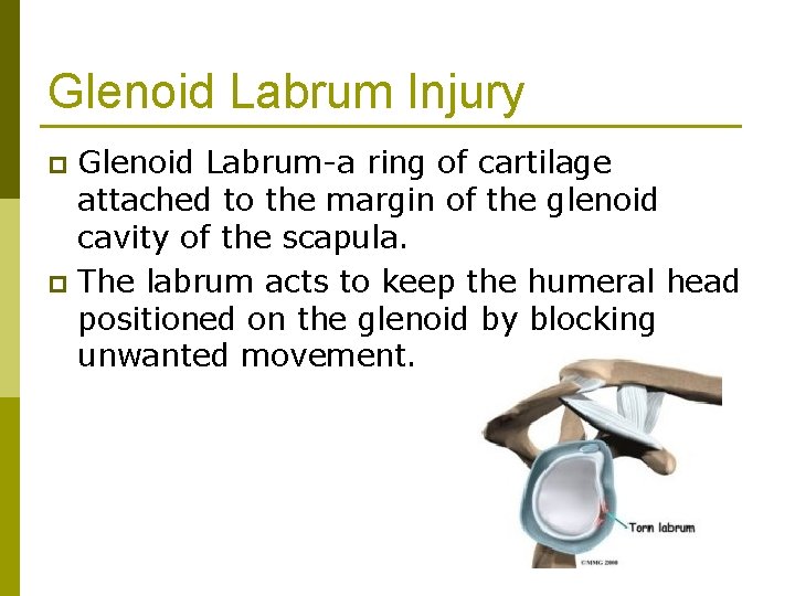 Glenoid Labrum Injury Glenoid Labrum-a ring of cartilage attached to the margin of the