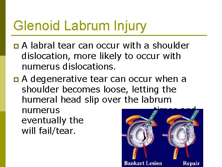 Glenoid Labrum Injury A labral tear can occur with a shoulder dislocation, more likely