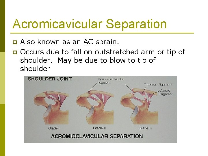 Acromicavicular Separation p p Also known as an AC sprain. Occurs due to fall