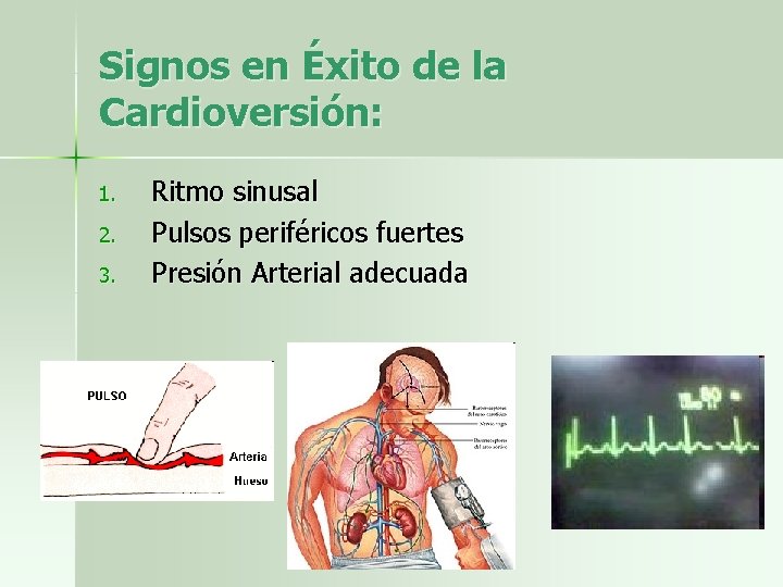 Signos en Éxito de la Cardioversión: 1. 2. 3. Ritmo sinusal Pulsos periféricos fuertes
