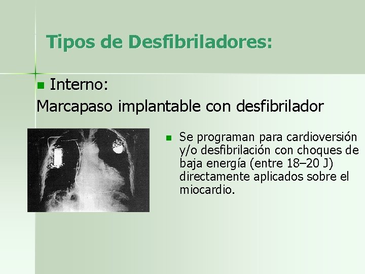 Tipos de Desfibriladores: Interno: Marcapaso implantable con desfibrilador n n Se programan para cardioversión