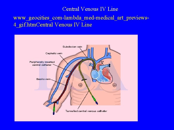 Central Venous IV Line www_geocities_com-lambda_med-medical_art_previews 4_gif. htm. Central Venous IV Line 