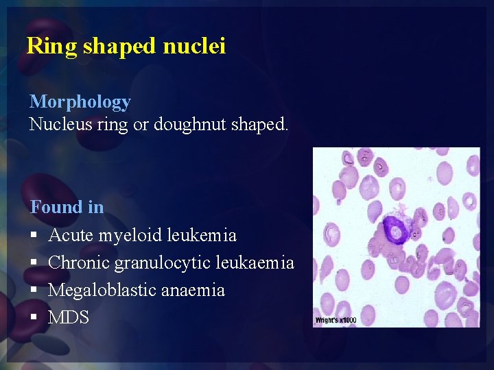 Ring shaped nuclei Morphology Nucleus ring or doughnut shaped. Found in § Acute myeloid