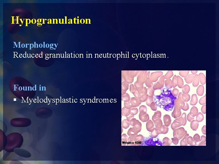 Hypogranulation Morphology Reduced granulation in neutrophil cytoplasm. Found in § Myelodysplastic syndromes 