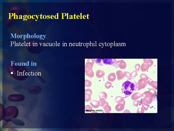 Phagocytosed Platelet Morphology Platelet in vacuole in neutrophil cytoplasm Found in § Infection 