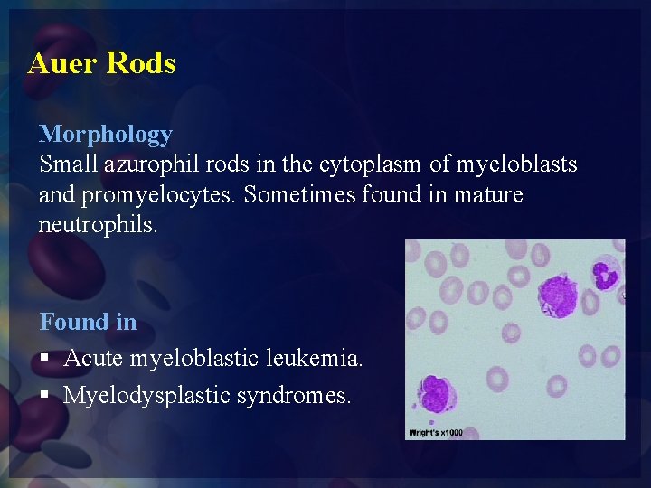 Auer Rods Morphology Small azurophil rods in the cytoplasm of myeloblasts and promyelocytes. Sometimes