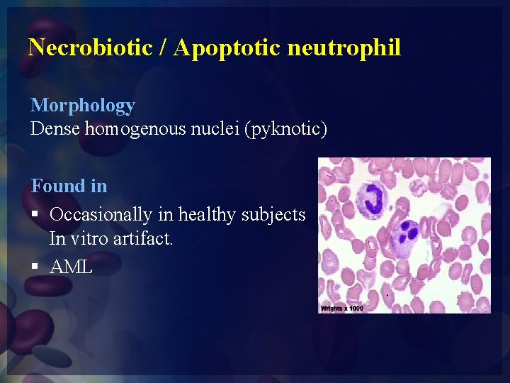 Necrobiotic / Apoptotic neutrophil Morphology Dense homogenous nuclei (pyknotic) Found in § Occasionally in