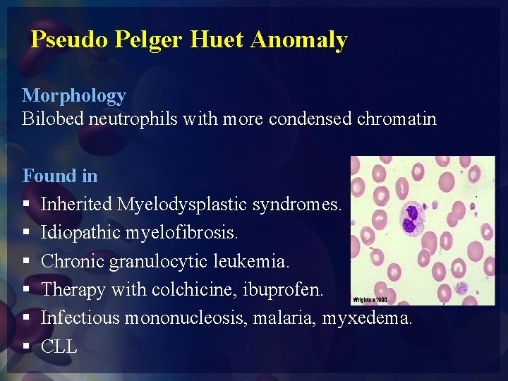 Pseudo Pelger Huet Anomaly Morphology Bilobed neutrophils with more condensed chromatin Found in §