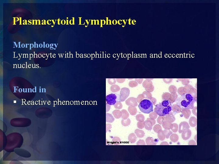Plasmacytoid Lymphocyte Morphology Lymphocyte with basophilic cytoplasm and eccentric nucleus. Found in § Reactive