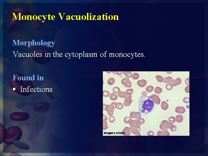 Monocyte Vacuolization Morphology Vacuoles in the cytoplasm of monocytes. Found in § Infections 