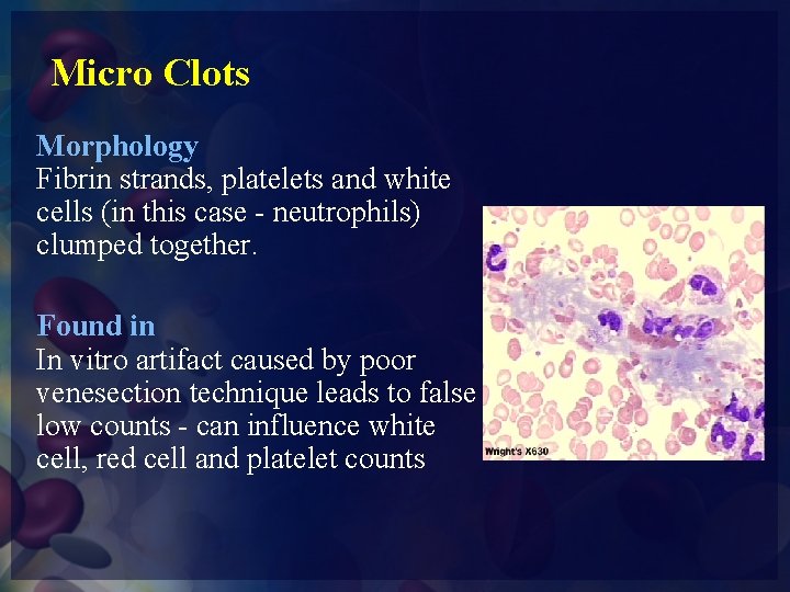 Micro Clots Morphology Fibrin strands, platelets and white cells (in this case - neutrophils)