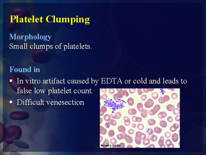 Platelet Clumping Morphology Small clumps of platelets. Found in § In vitro artifact caused