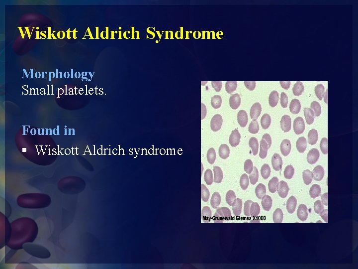Wiskott Aldrich Syndrome Morphology Small platelets. Found in § Wiskott Aldrich syndrome 