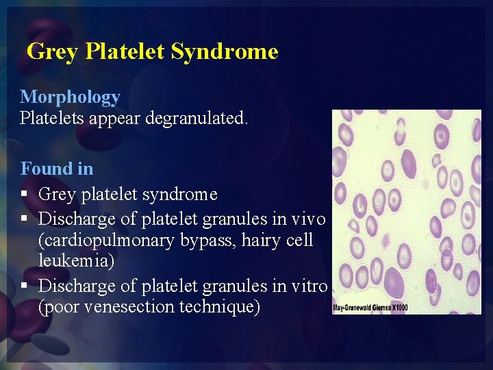 Grey Platelet Syndrome Morphology Platelets appear degranulated. Found in § Grey platelet syndrome §