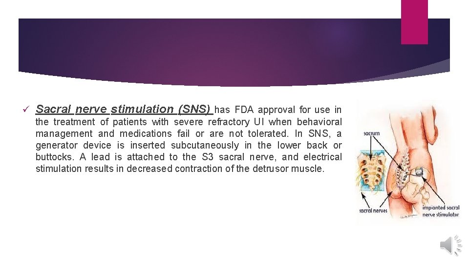 ü Sacral nerve stimulation (SNS) has FDA approval for use in the treatment of