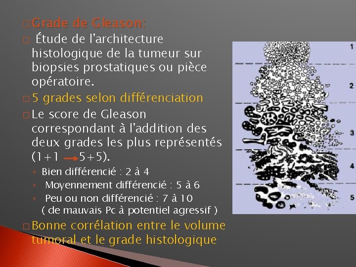 � Grade � Étude de Gleason: de l'architecture histologique de la tumeur sur biopsies