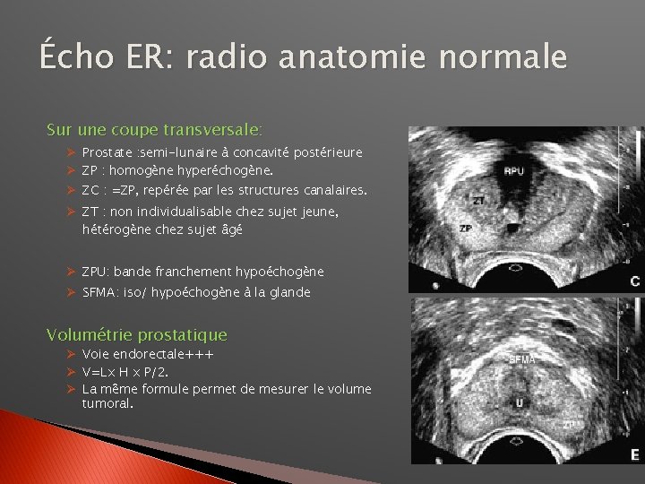 Écho ER: radio anatomie normale Sur une coupe transversale: Ø Prostate : semi-lunaire à
