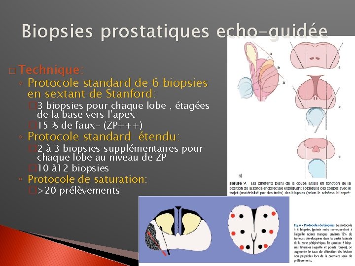 Biopsies prostatiques echo-guidée � Technique: ◦ Protocole standard de 6 biopsies en sextant de