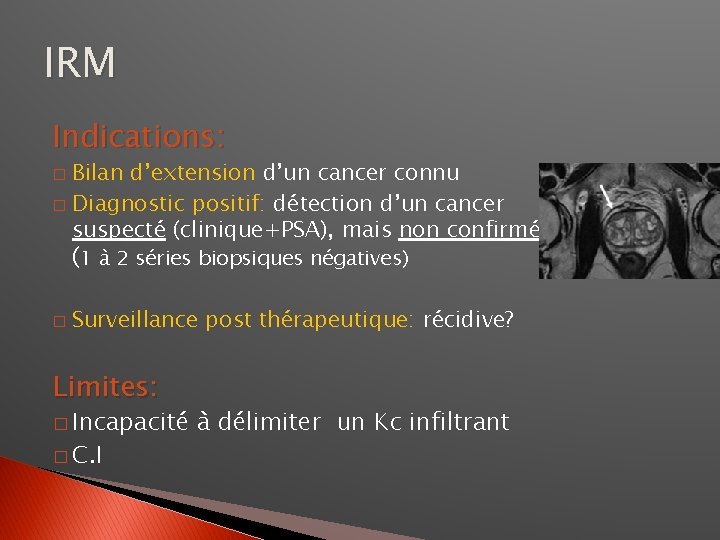 IRM Indications: Bilan d’extension d’un cancer connu � Diagnostic positif: détection d’un cancer suspecté