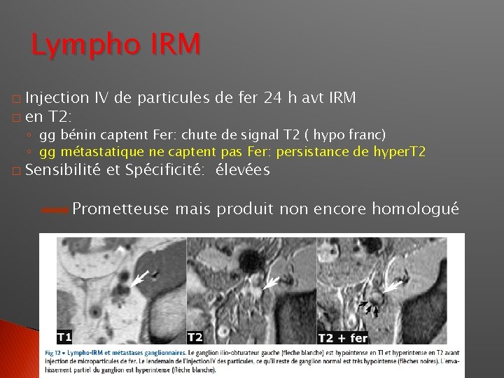 Lympho IRM Injection IV de particules de fer 24 h avt IRM � en