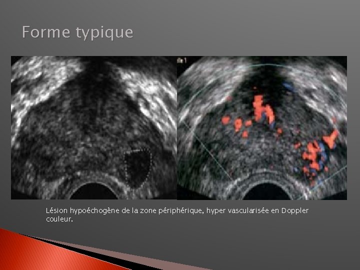 Forme typique Lésion hypoéchogène de la zone périphérique, hyper vascularisée en Doppler couleur. 