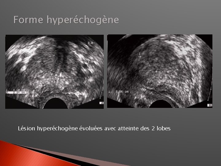 Forme hyperéchogène Lésion hyperéchogène évoluées avec atteinte des 2 lobes 