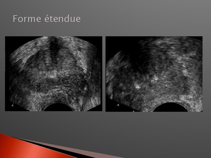 Forme étendue 
