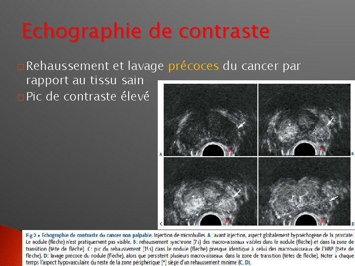 Echographie de contraste � Rehaussement et lavage précoces du cancer par rapport au tissu