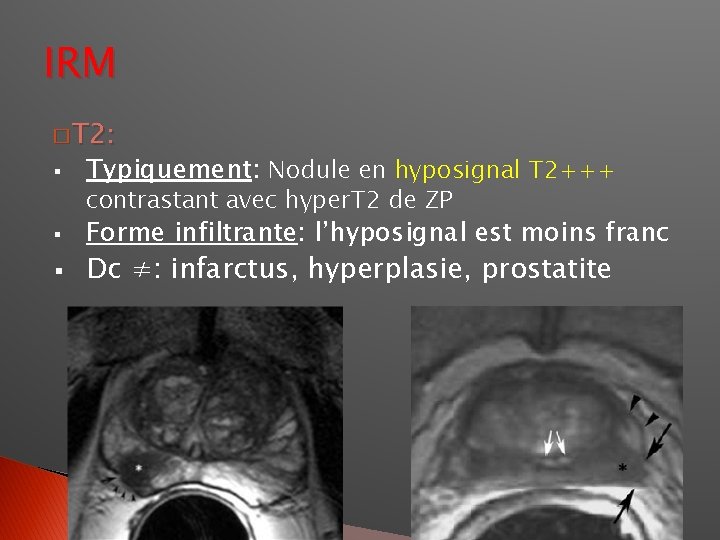 IRM � T 2: § Typiquement: Nodule en hyposignal T 2+++ § Forme infiltrante: