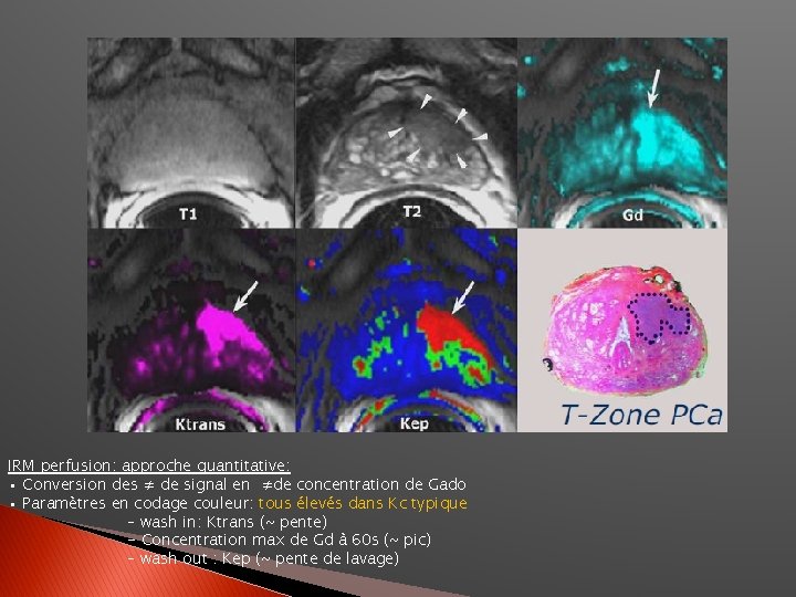 IRM perfusion: approche quantitative: • Conversion des ≠ de signal en ≠de concentration de