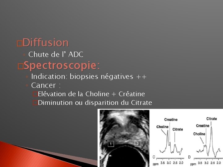 �Diffusion ◦ Chute de l’ ADC �Spectroscopie: ◦ Indication: biopsies négatives ++ ◦ Cancer