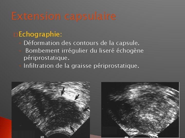 Extension capsulaire � Echographie: ◦ Déformation des contours de la capsule. ◦ Bombement irrégulier