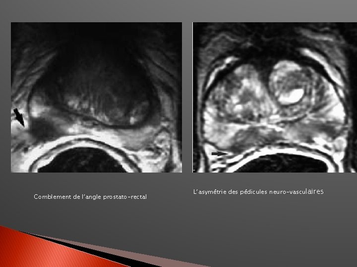 Comblement de l’angle prostato-rectal L’asymétrie des pédicules neuro-vasculaires 