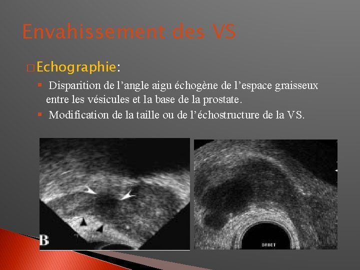 Envahissement des VS � Echographie: § Disparition de l’angle aigu échogène de l’espace graisseux