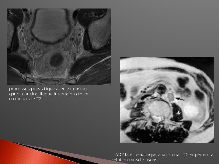 processus prostatique avec extension ganglionnaire iliaque interne droite en coupe axiale T 2 L’ADP