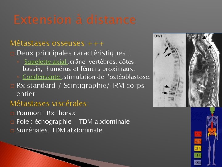 Extension à distance Métastases osseuses +++ � Deux principales caractéristiques : ◦ Squelette axial