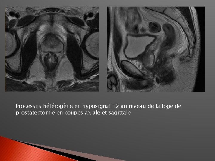 Processus hétérogène en hyposignal T 2 an niveau de la loge de prostatectomie en