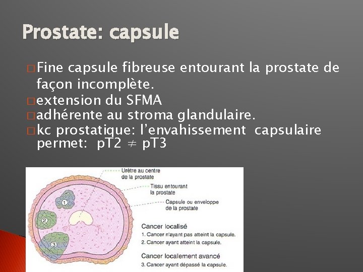 Prostate: capsule � Fine capsule fibreuse entourant la prostate de façon incomplète. � extension