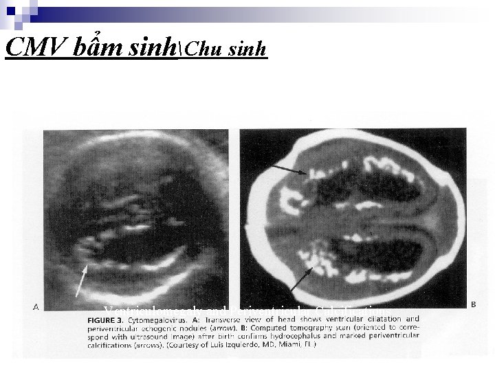 CMV bẩm sinhChu sinh Ventriculomegaly and Periventricular Calcifications 