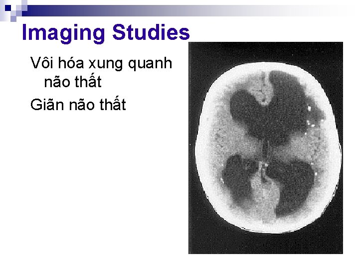 Imaging Studies Vôi hóa xung quanh não thất Giãn não thất 