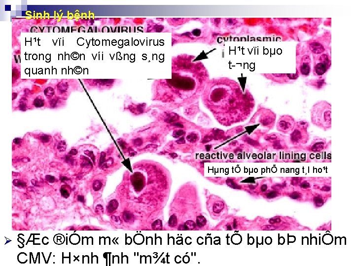 Sinh lý bệnh H¹t vïi Cytomegalovirus trong nh©n víi vßng s¸ng quanh nh©n H¹t