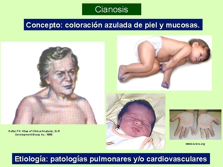 Cianosis Concepto: coloración azulada de piel y mucosas. Netter FH: Atlas of Clinical Anatomy,